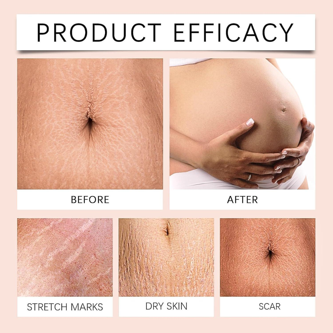 Hakim Suleman's Stretch Mark & Scar Removal Cream | Enriched with Almond, Olive & Sandalwood Oil | Reduces Stretch Marks, Scars & Improves Skin Elasticity