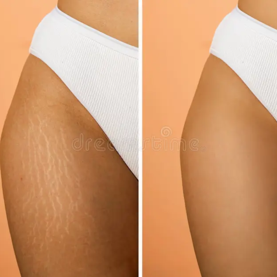 Hakim Suleman's Stretch Mark & Scar Removal Cream | Enriched with Almond, Olive & Sandalwood Oil | Reduces Stretch Marks, Scars & Improves Skin Elasticity