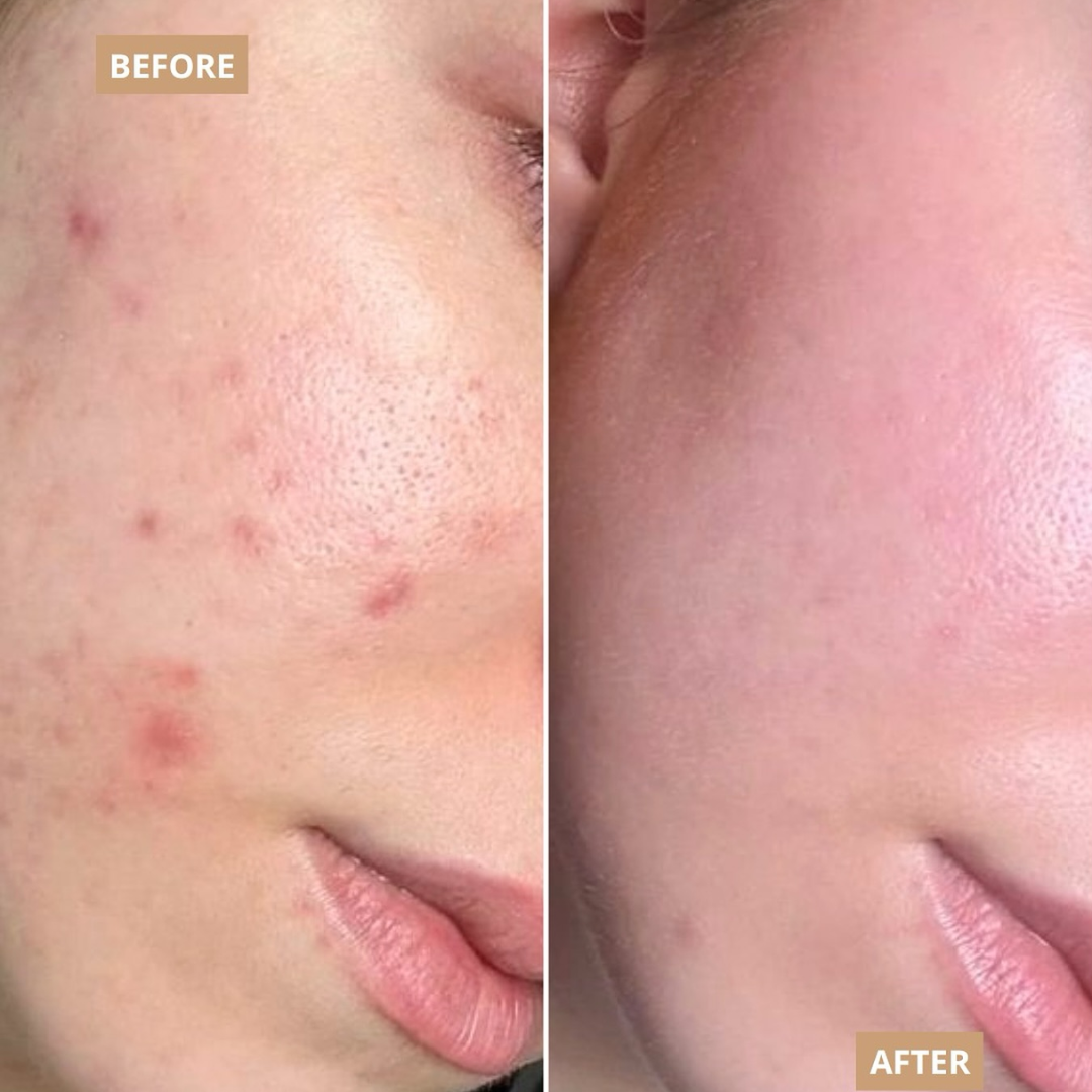 L'Oreal pink Exfoliating Peel | Facial Like Glow in Just 15 minutes | Anti dark spot, Pore minimizing, Brighten Skin tone