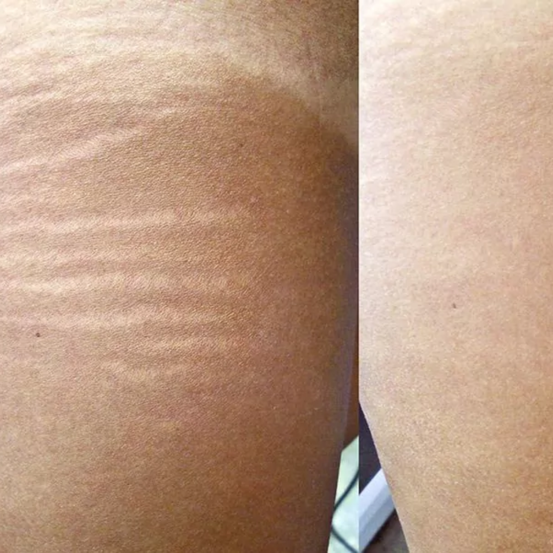 Hakim Suleman's Stretch Mark & Scar Removal Cream | Enriched with Almond, Olive & Sandalwood Oil | Reduces Stretch Marks, Scars & Improves Skin Elasticity