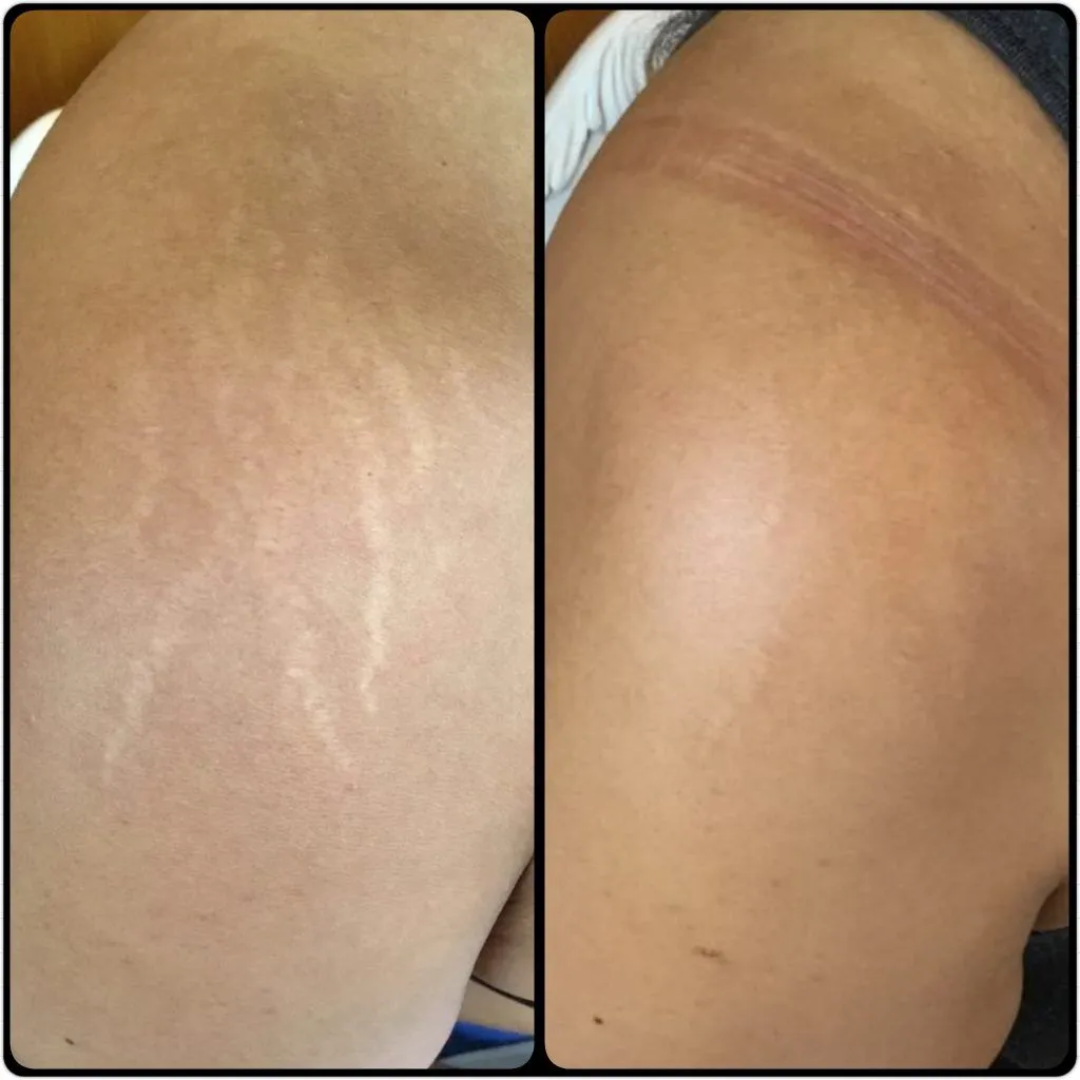 Hakim Suleman's Stretch Mark & Scar Removal Cream | Enriched with Almond, Olive & Sandalwood Oil | Reduces Stretch Marks, Scars & Improves Skin Elasticity