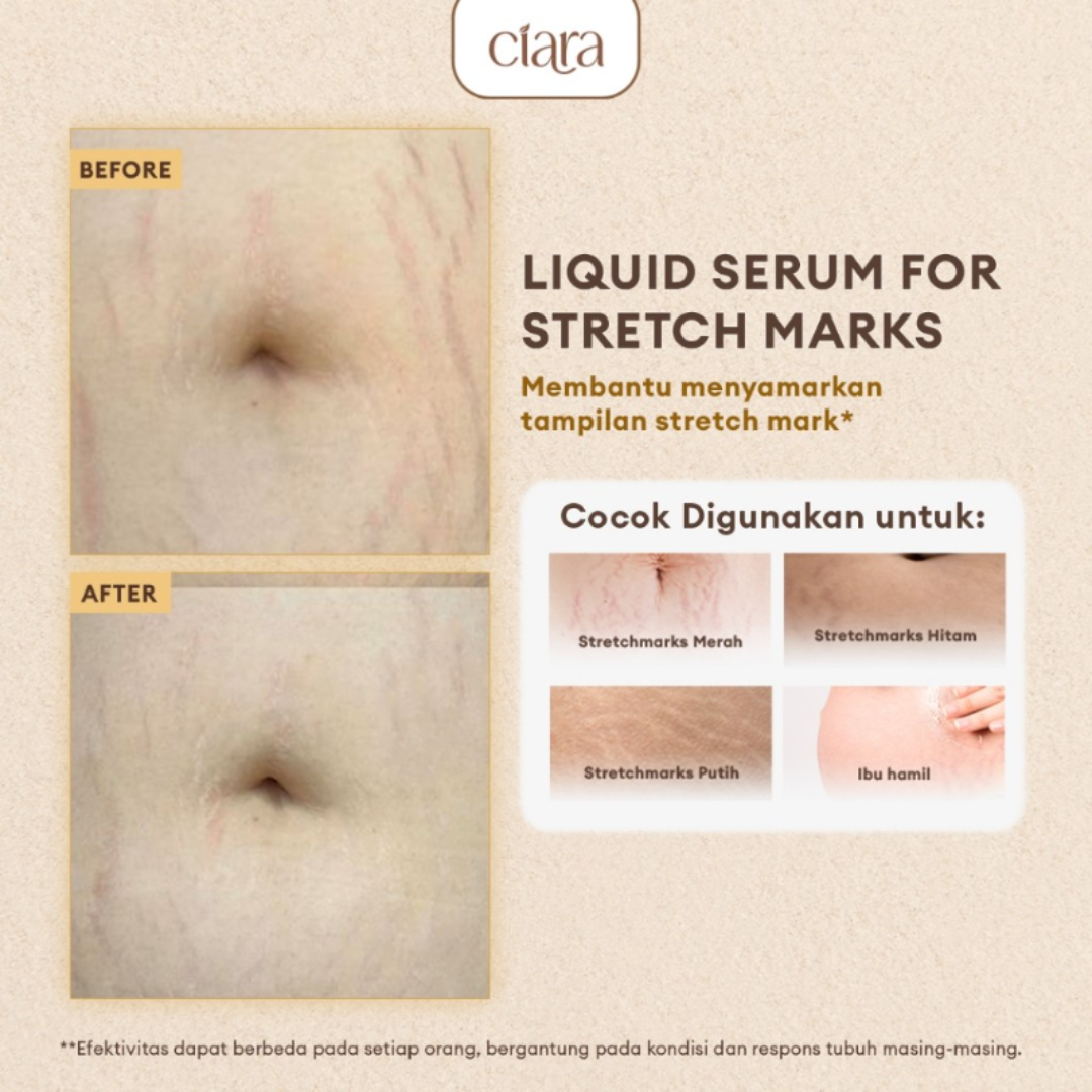 Ciara Liquid Serum for Stretch Marks | 6X Hyaluronic Acid + Squalane + Collagen | Fades Stretch Marks, Boosts Elasticity & Deep Skin Repair