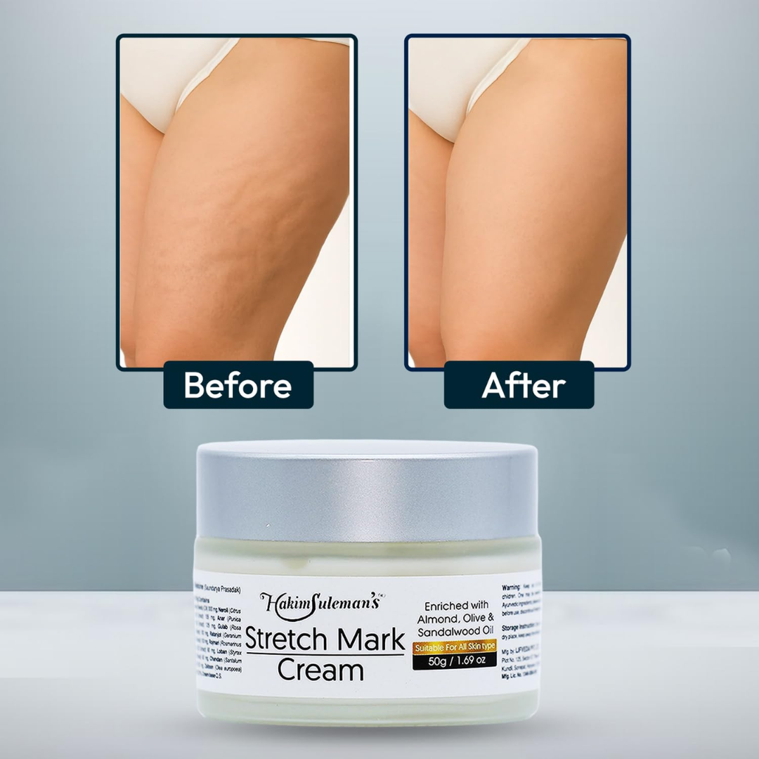 Hakim Suleman's Stretch Mark & Scar Removal Cream | Enriched with Almond, Olive & Sandalwood Oil | Reduces Stretch Marks, Scars & Improves Skin Elasticity