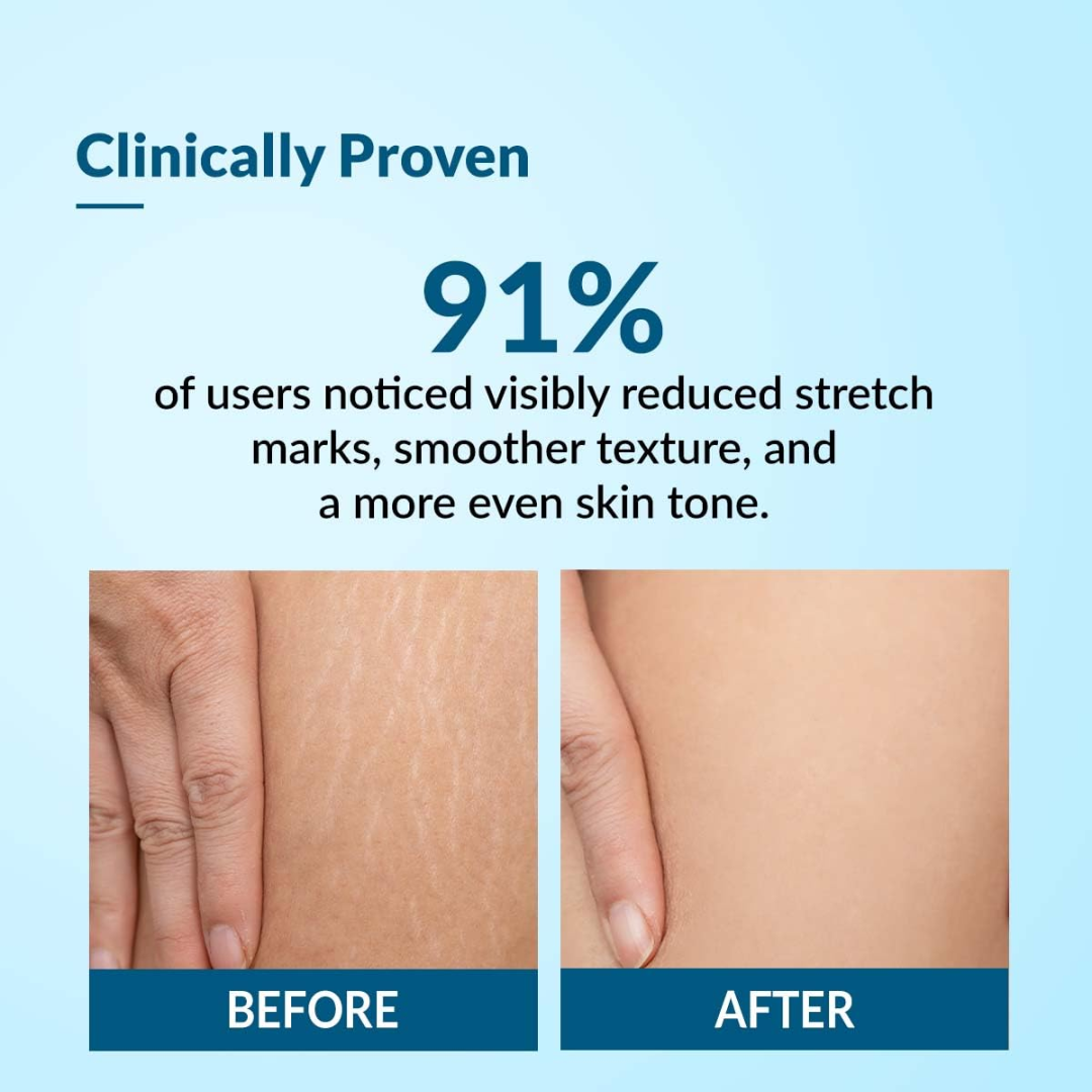 Hakim Suleman's Stretch Mark & Scar Removal Cream | Enriched with Almond, Olive & Sandalwood Oil | Reduces Stretch Marks, Scars & Improves Skin Elasticity