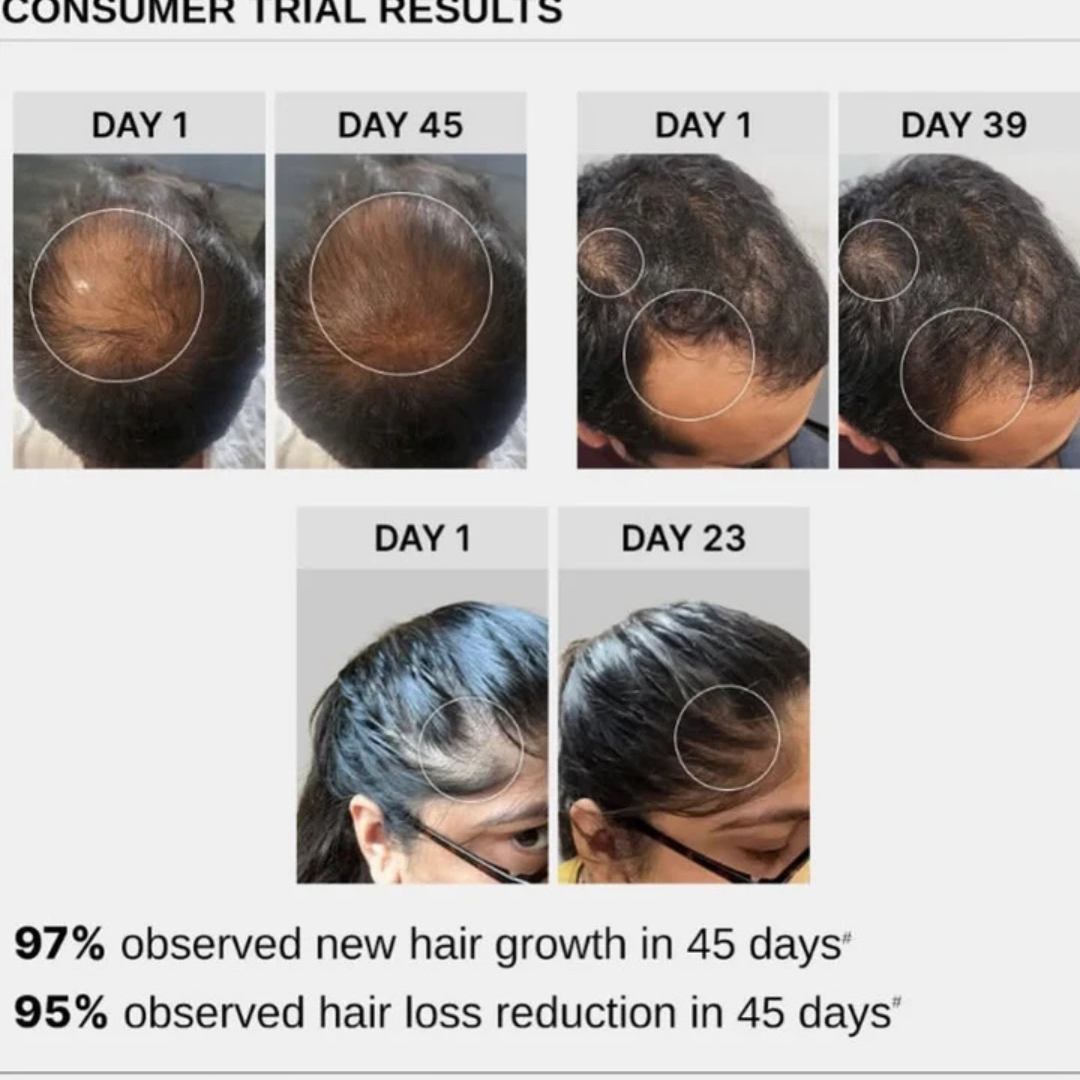 Bare Anatomy Advanced Hair Growth Roll-On Serum | 3% Redensyl + 4% Anagain + 2% Baicapil + 5% Rosemary | Direct Scalp Application for Thicker, Stronger Hair