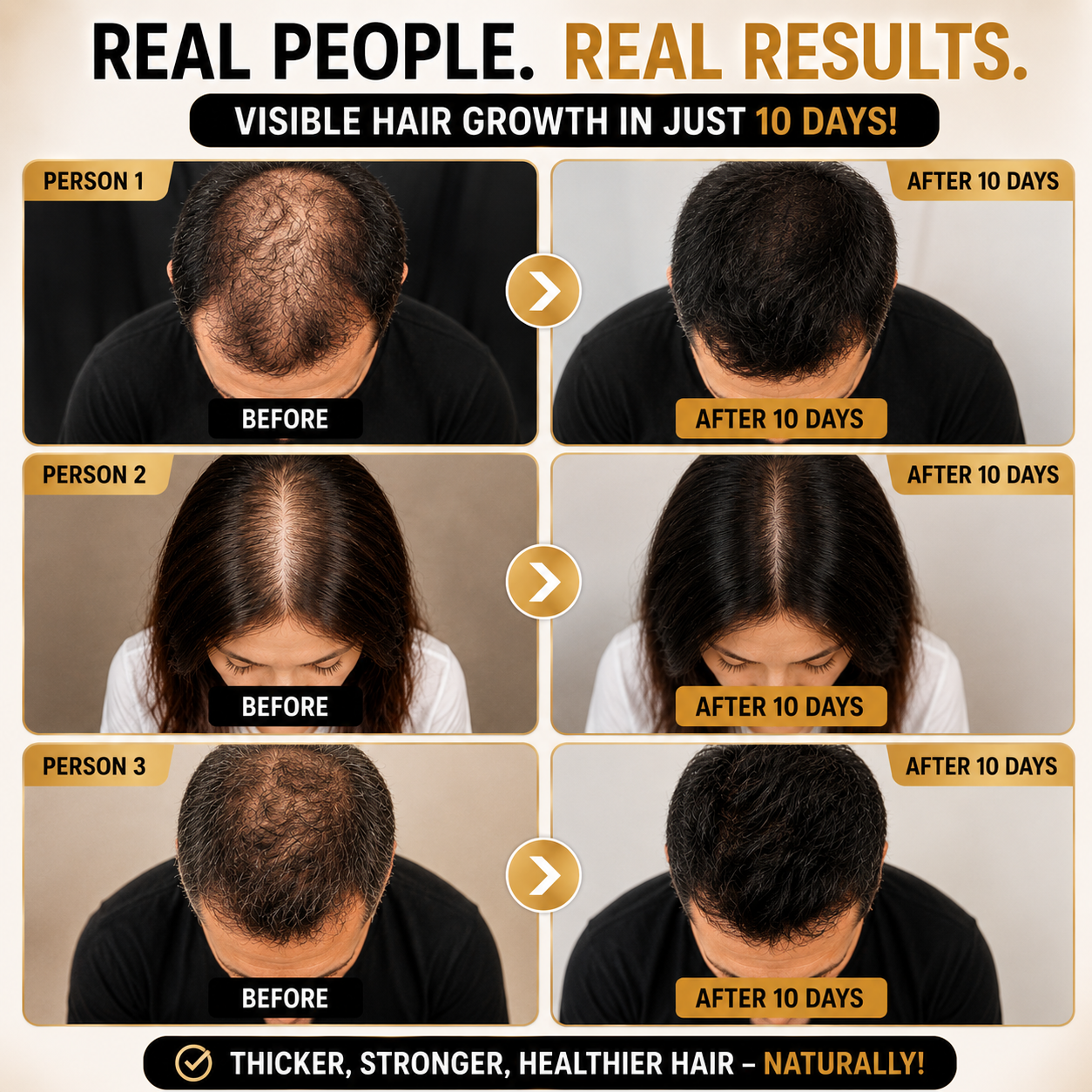 BARE ANATOMY Advanced Hair Growth Serum – Visible Results in 10 Days – Reduces Hair Fall by 89% – Promotes New Growth, Increases Density